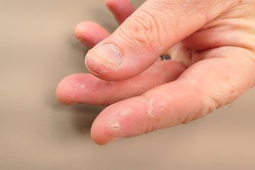 Dyshydrotic Eczema on Finger